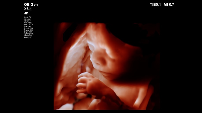 TrueVue X6-1, feto de 27 semanas