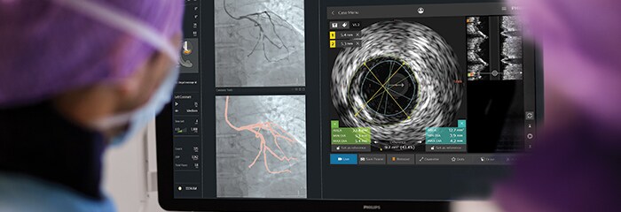 Ventana emergente del tratamiento de coronariopatías con IntraSight