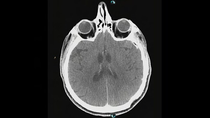 Aneurisma cerebral