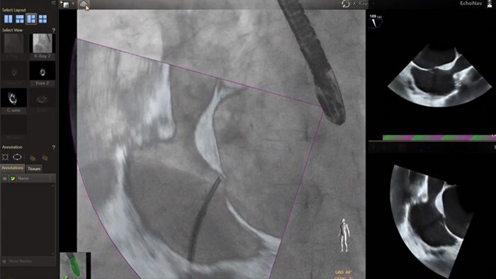 Modelos EchoNav aorta-mitral