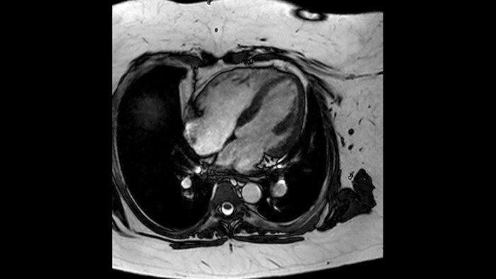 bTFE 4 chamber view obese patient
