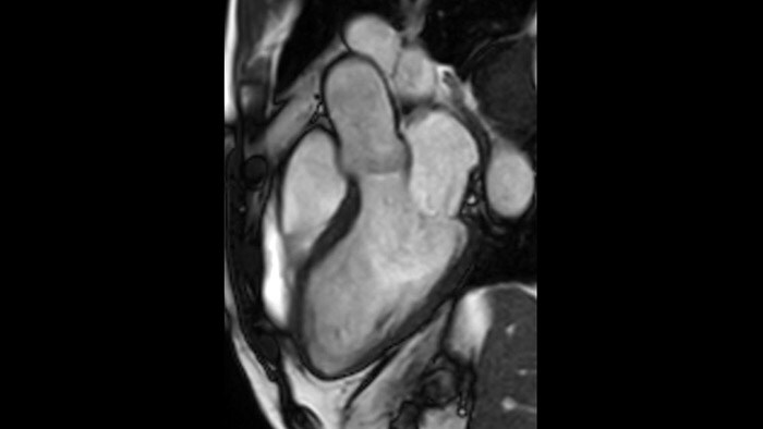bTFE left ventricular outflow tract