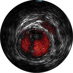 chromaflo ivus sfa dr dippel 7