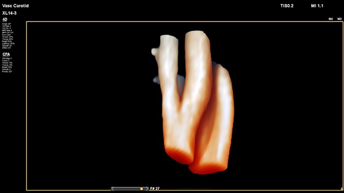 Evaluación sencilla de la composición y ubicación espacial de las placas, además de datos del flujo 3D para estudiar las anomalías relacionadas con la estenosis o la tortuosidad