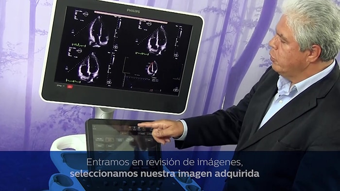 AutoStrain ventrículo derecho