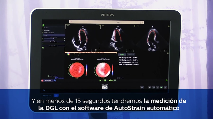 AutoStrain ventrículo izquierdo