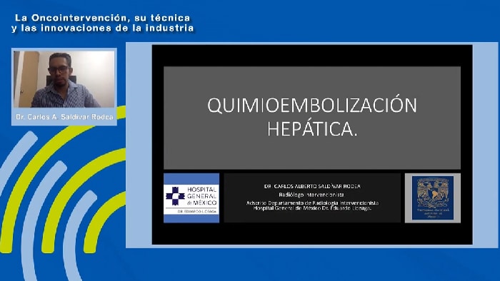 Quimioembolización hepática (TACE) – Dr. Carlos Alberto Saldivar Rodea
