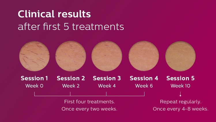Clinical results after first 5 treatments