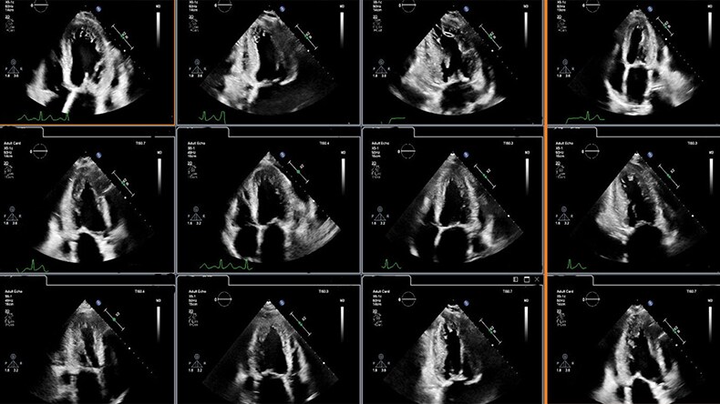 Clinical image showing cardiac ultrasound display for image analysis enhanced through integration of AI